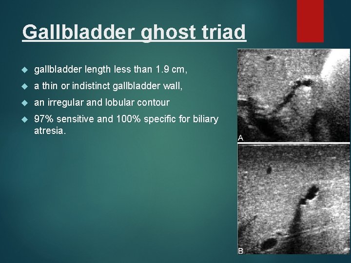 Gallbladder ghost triad gallbladder length less than 1. 9 cm, a thin or indistinct