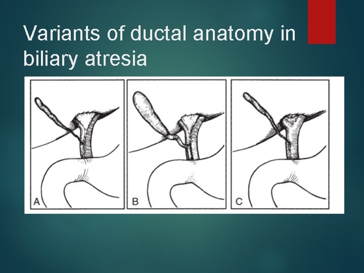 Variants of ductal anatomy in biliary atresia 