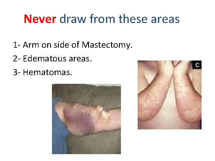  Never draw from these areas 1 - Arm on side of Mastectomy. 2