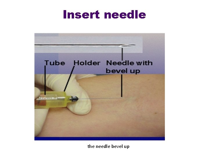Insert needle the needle bevel up 