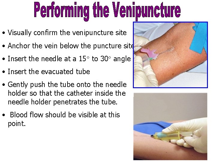  • Visually confirm the venipuncture site • Anchor the vein below the puncture