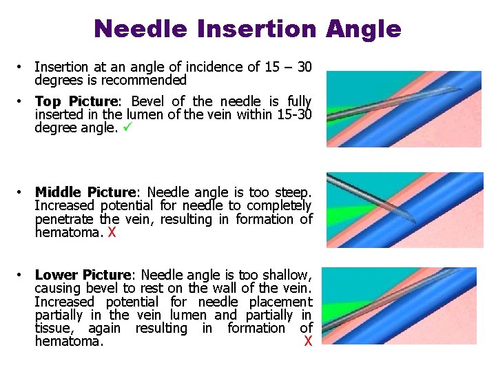 Needle Insertion Angle • Insertion at an angle of incidence of 15 – 30