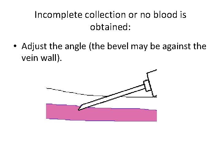Incomplete collection or no blood is obtained: • Adjust the angle (the bevel may