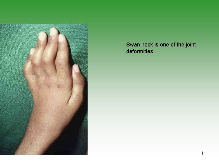 Swan neck is one of the joint deformities. 11 