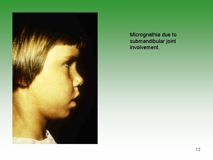 Micrognathia due to submandibular joint involvement. 12 
