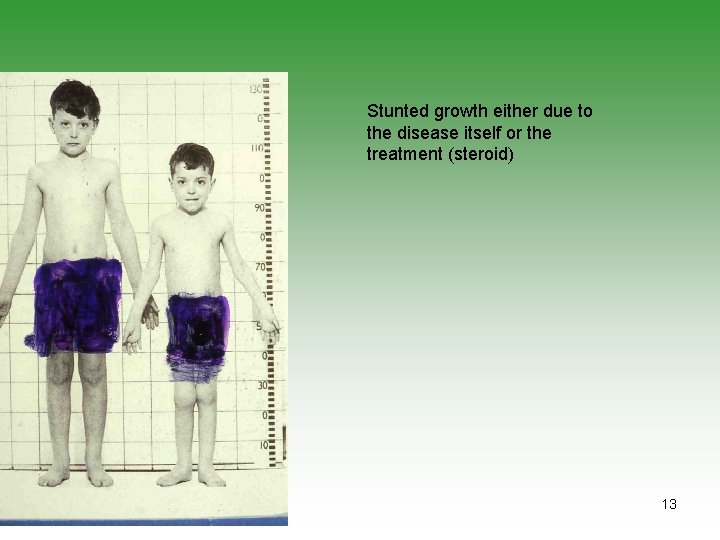 Stunted growth either due to the disease itself or the treatment (steroid) 13 