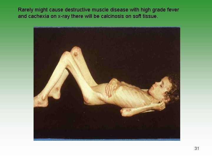 Rarely might cause destructive muscle disease with high grade fever and cachexia on x-ray