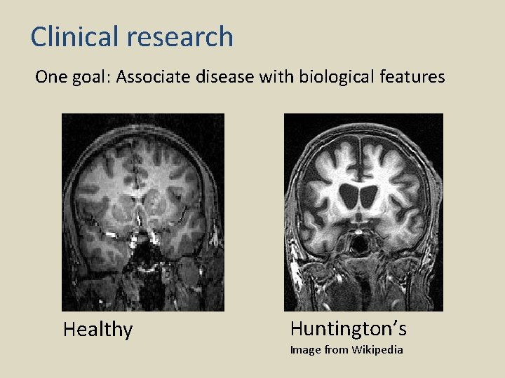 Clinical research One goal: Associate disease with biological features Healthy Huntington’s Image from Wikipedia