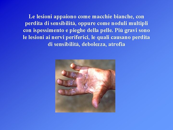 Le lesioni appaiono come macchie bianche, con perdita di sensibilità, oppure come noduli multipli