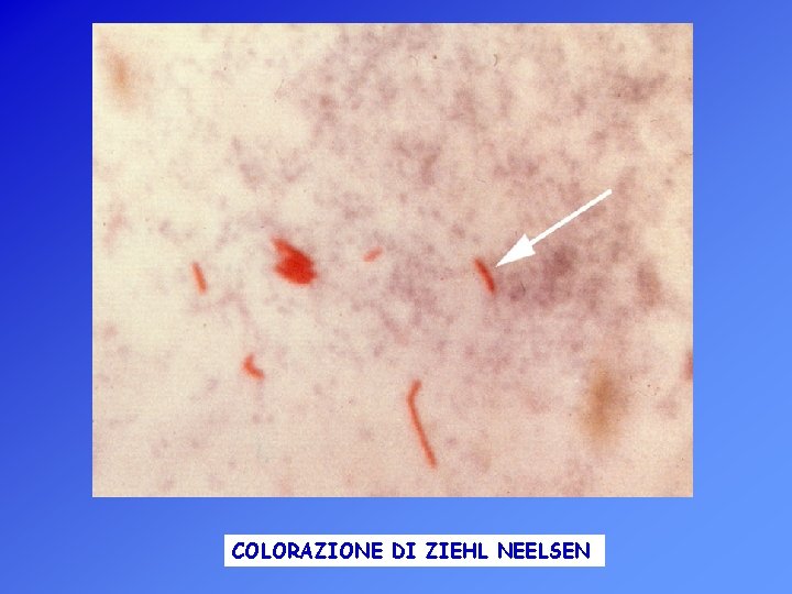 COLORAZIONE DI ZIEHL NEELSEN 