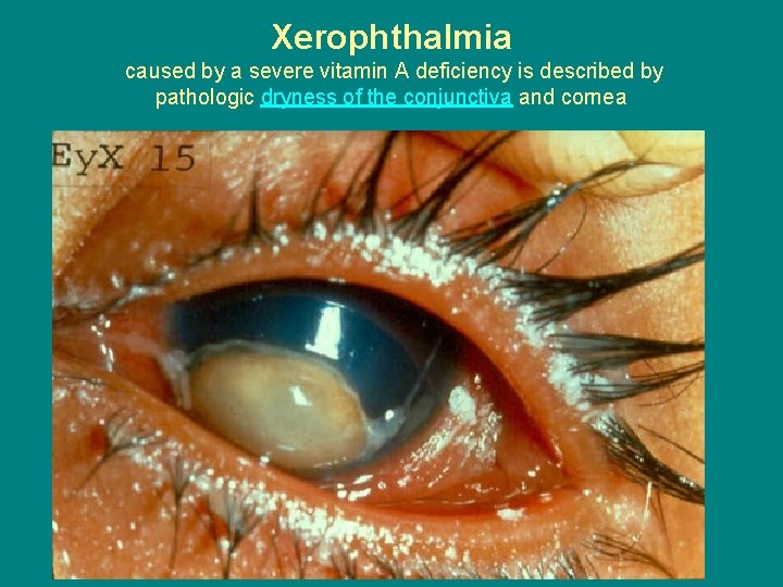 Xerophthalmia caused by a severe vitamin A deficiency is described by pathologic dryness of
