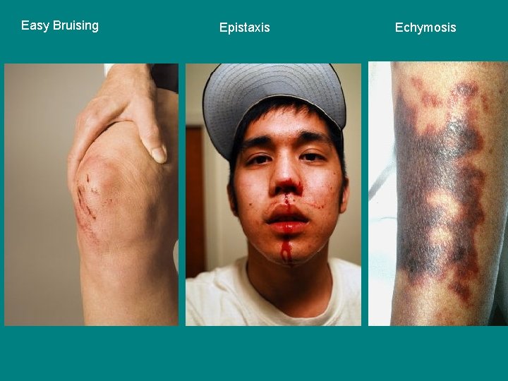 Easy Bruising Epistaxis Echymosis 