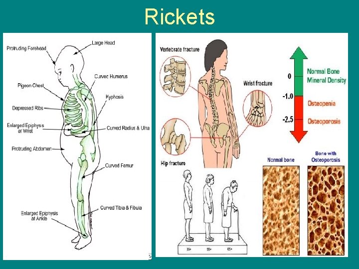 Rickets 