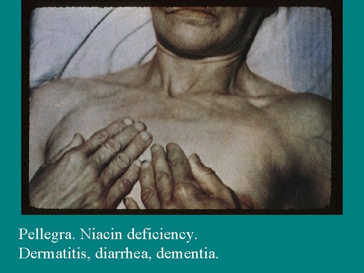 Pellegra. Niacin deficiency. Dermatitis, diarrhea, dementia. 