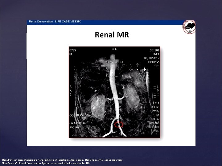 Results from case studies are not predictive of results in other cases. Results in