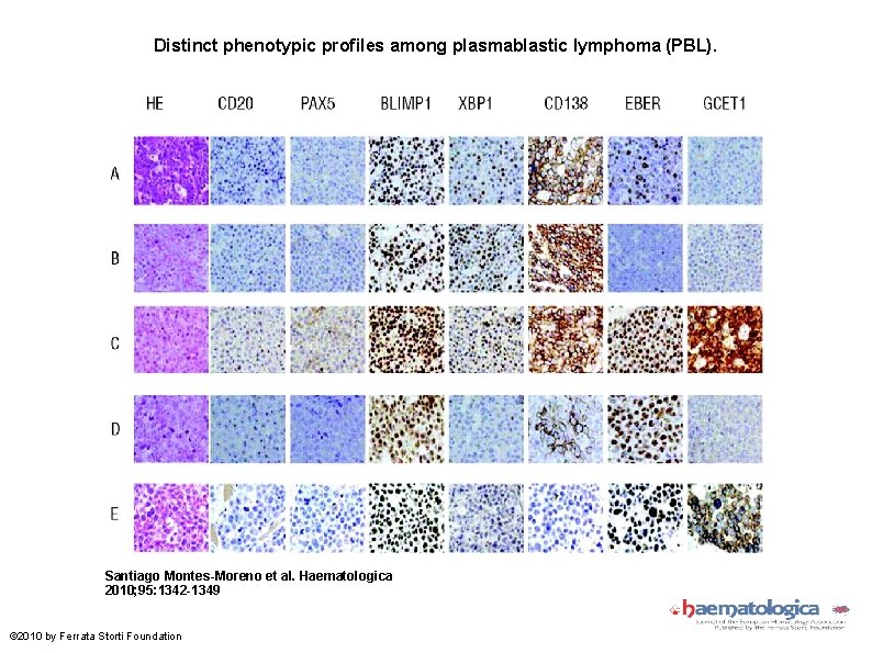 Distinct phenotypic profiles among plasmablastic lymphoma (PBL). Santiago Montes-Moreno et al. Haematologica 2010; 95: