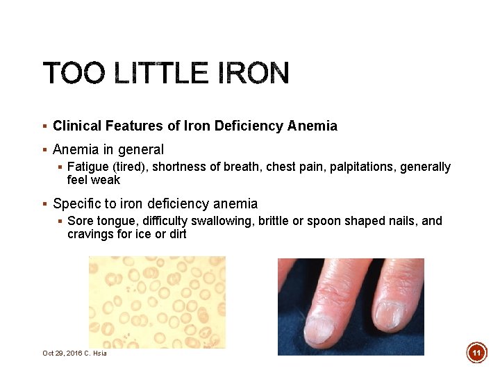 § Clinical Features of Iron Deficiency Anemia § Anemia in general § Fatigue (tired),