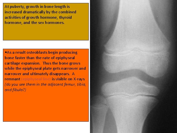 At puberty, growth in bone length is increased dramatically by the combined activities of