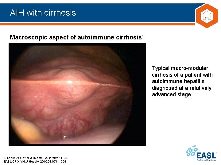 AIH with cirrhosis Macroscopic aspect of autoimmune cirrhosis 1 Typical macro-modular cirrhosis of a