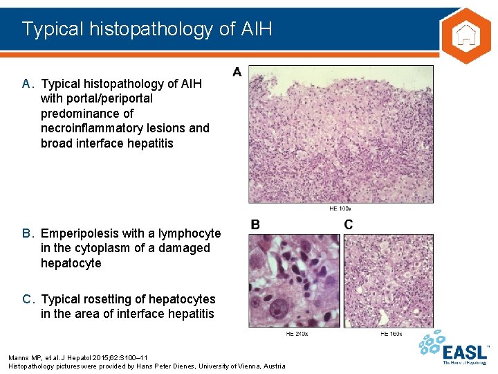 Typical histopathology of AIH A. Typical histopathology of AIH with portal/periportal predominance of necroinflammatory