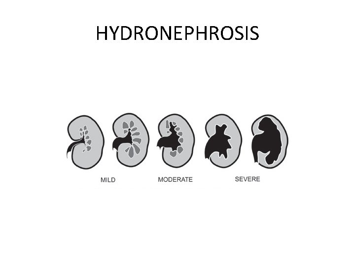 HYDRONEPHROSIS 