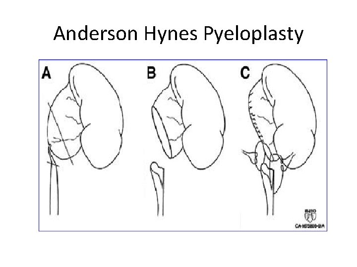 Anderson Hynes Pyeloplasty 
