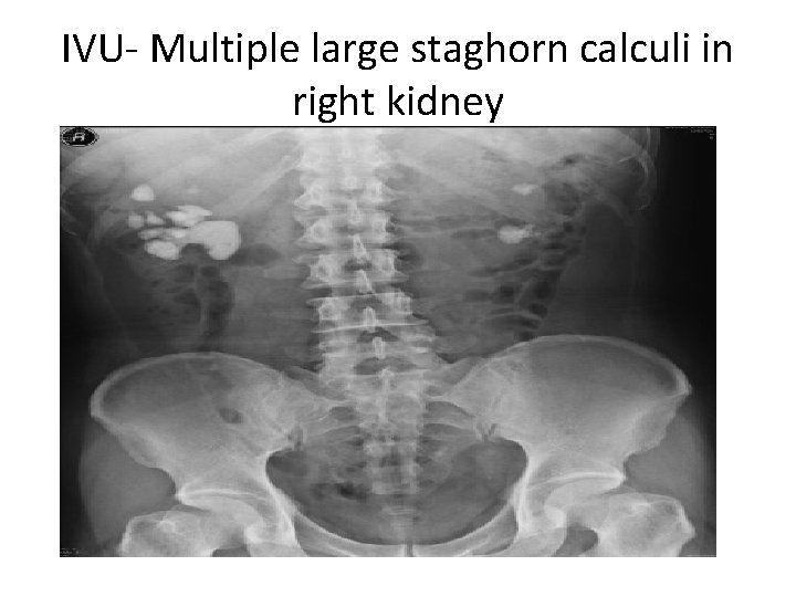 IVU- Multiple large staghorn calculi in right kidney 