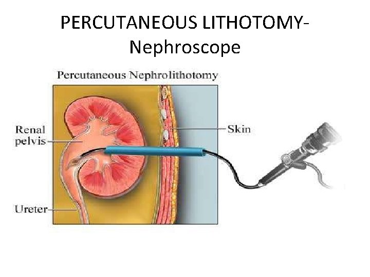 PERCUTANEOUS LITHOTOMYNephroscope 