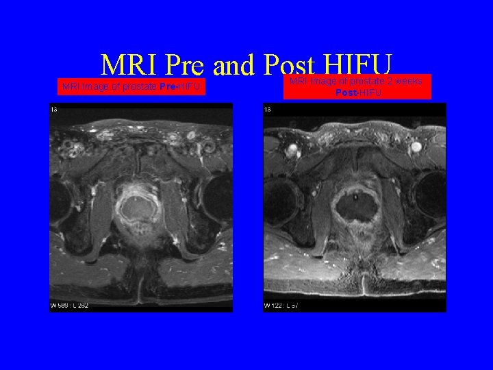 MRI Pre and Post HIFU MRI Image of prostate Pre-HIFU MRI Image of prostate