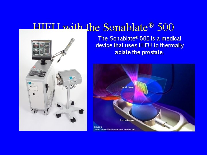HIFU with the Sonablate® 500 The Sonablate® 500 is a medical device that uses