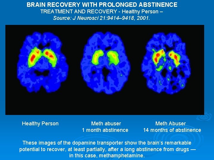 BRAIN RECOVERY WITH PROLONGED ABSTINENCE TREATMENT AND RECOVERY - Healthy Person – Source: J