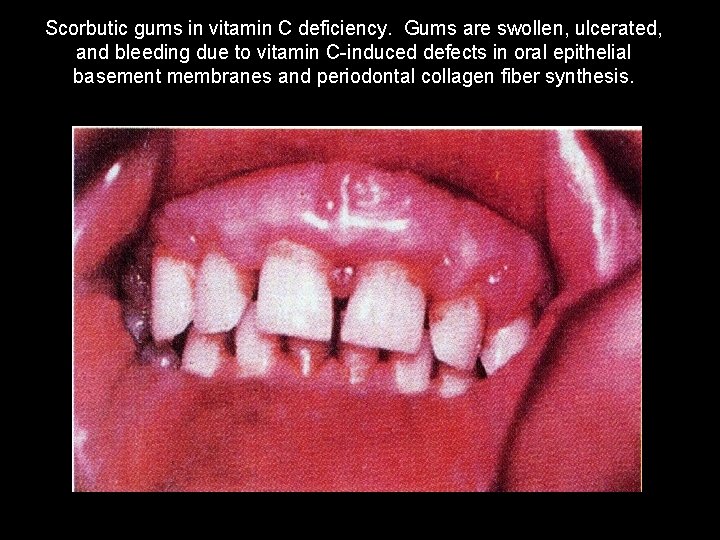 Scorbutic gums in vitamin C deficiency. Gums are swollen, ulcerated, and bleeding due to