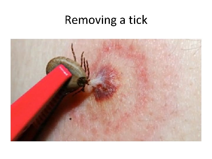 Removing a tick 