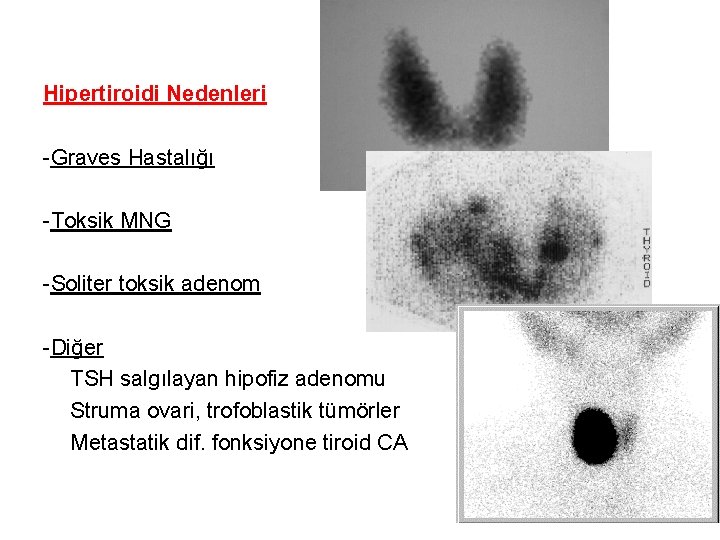 Hipertiroidi Nedenleri -Graves Hastalığı -Toksik MNG -Soliter toksik adenom -Diğer TSH salgılayan hipofiz adenomu