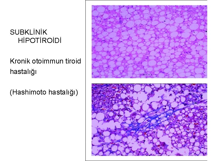 SUBKLİNİK HİPOTİROİDİ Kronik otoimmun tiroid hastalığı (Hashimoto hastalığı) 