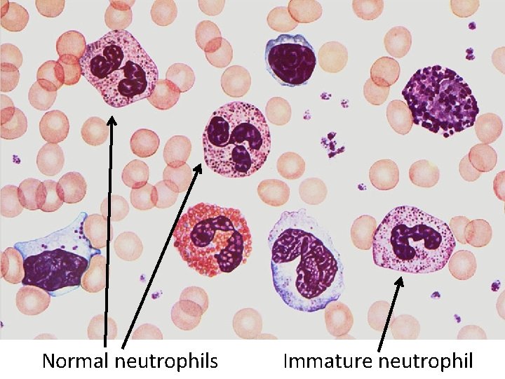 Normal neutrophils Immature neutrophil 
