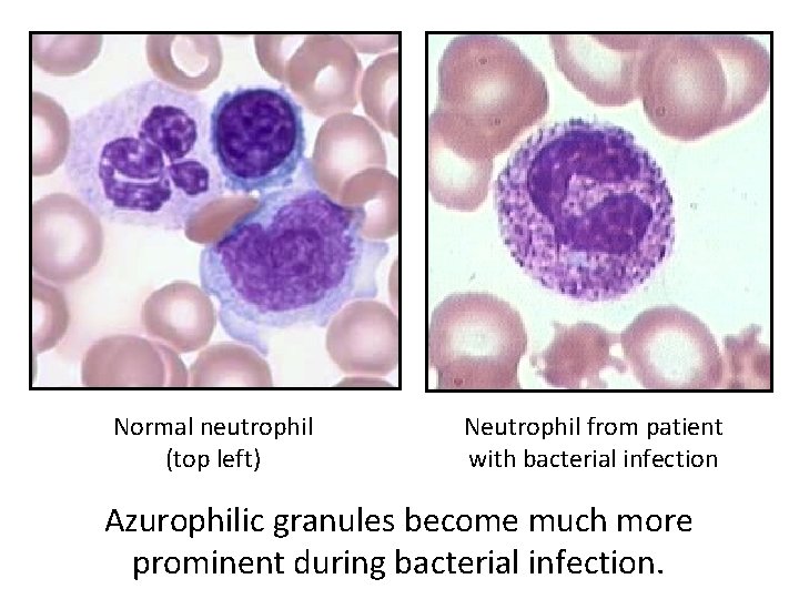 Normal neutrophil (top left) Neutrophil from patient with bacterial infection Azurophilic granules become much