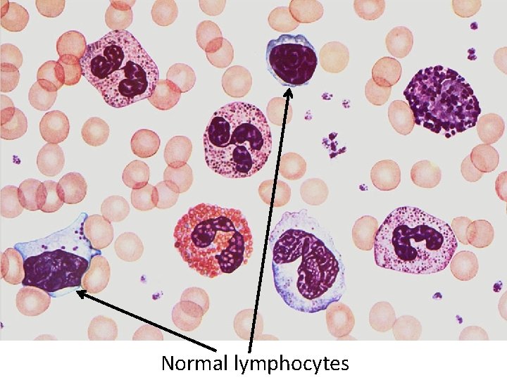 Normal lymphocytes 