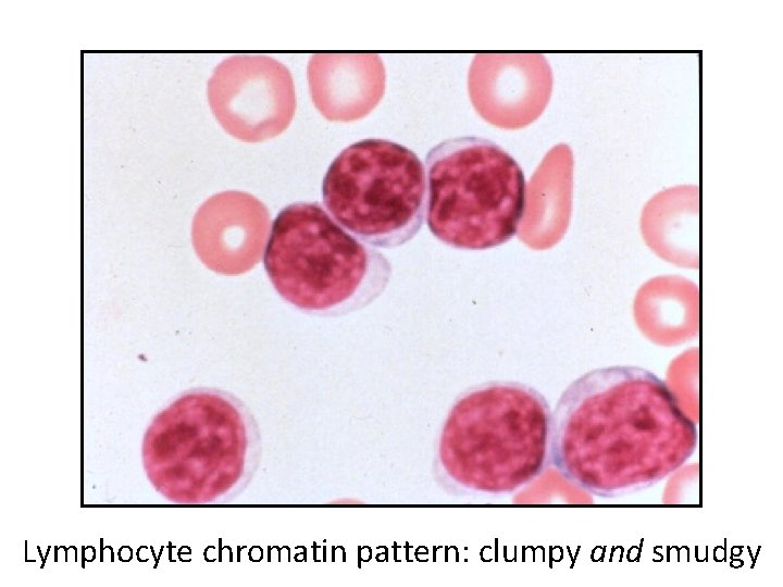 Lymphocyte chromatin pattern: clumpy and smudgy 