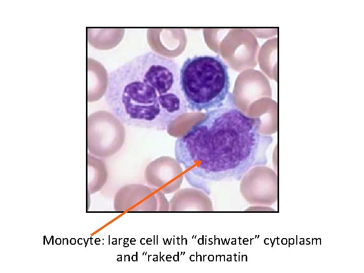 Monocyte: large cell with “dishwater” cytoplasm and “raked” chromatin 