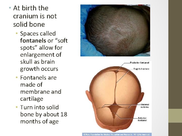  • At birth the cranium is not solid bone • Spaces called fontanels