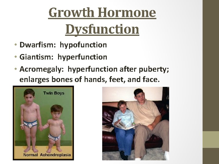 Growth Hormone Dysfunction • Dwarfism: hypofunction • Giantism: hyperfunction • Acromegaly: hyperfunction after puberty;