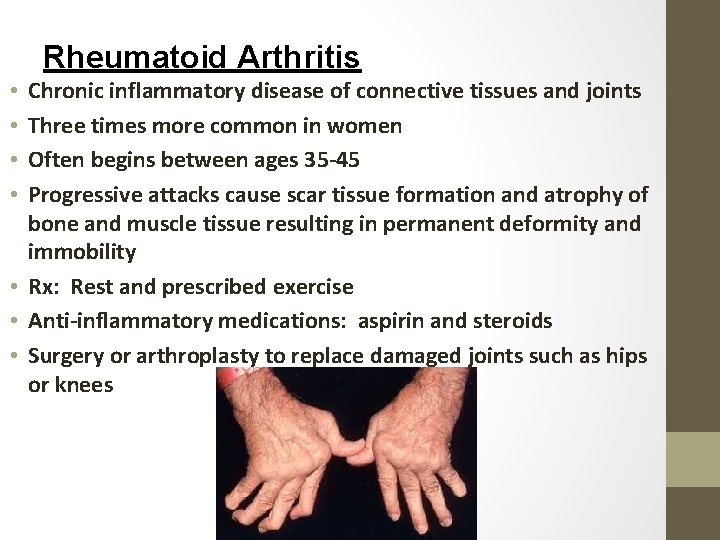 Rheumatoid Arthritis Chronic inflammatory disease of connective tissues and joints Three times more common