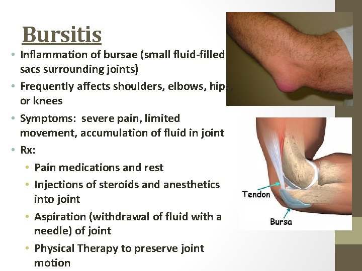 Bursitis • Inflammation of bursae (small fluid-filled sacs surrounding joints) • Frequently affects shoulders,