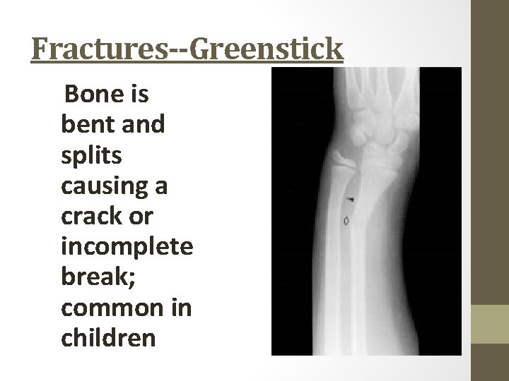 Fractures--Greenstick Bone is bent and splits causing a crack or incomplete break; common in