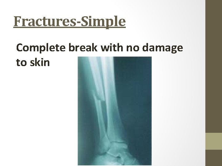 Fractures-Simple Complete break with no damage to skin 