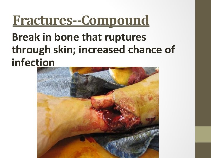 Fractures--Compound Break in bone that ruptures through skin; increased chance of infection 