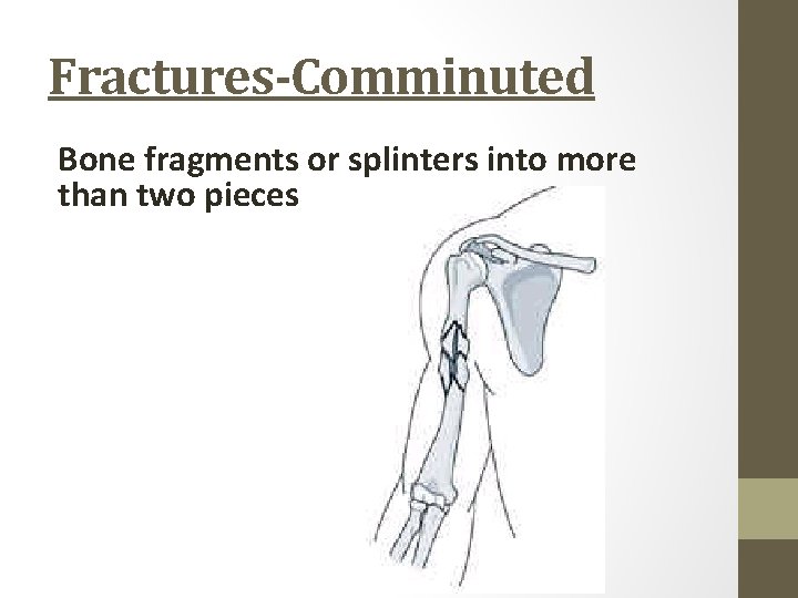 Fractures-Comminuted Bone fragments or splinters into more than two pieces 