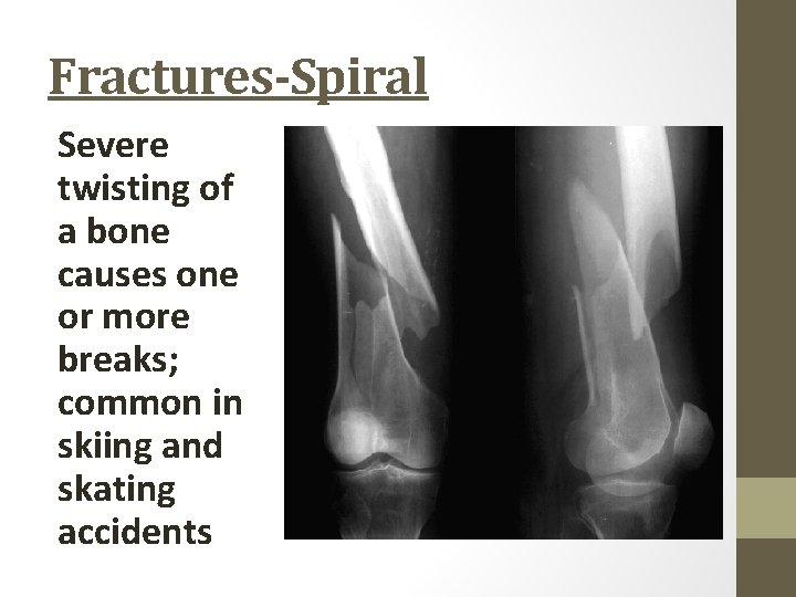 Fractures-Spiral Severe twisting of a bone causes one or more breaks; common in skiing