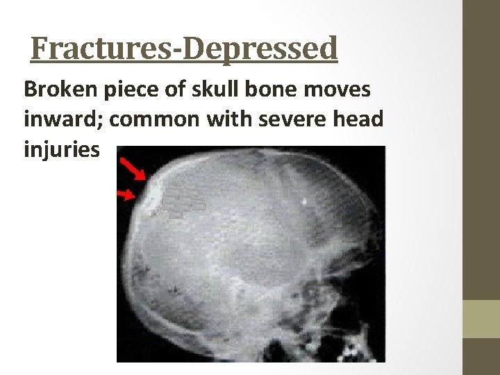 Fractures-Depressed Broken piece of skull bone moves inward; common with severe head injuries 